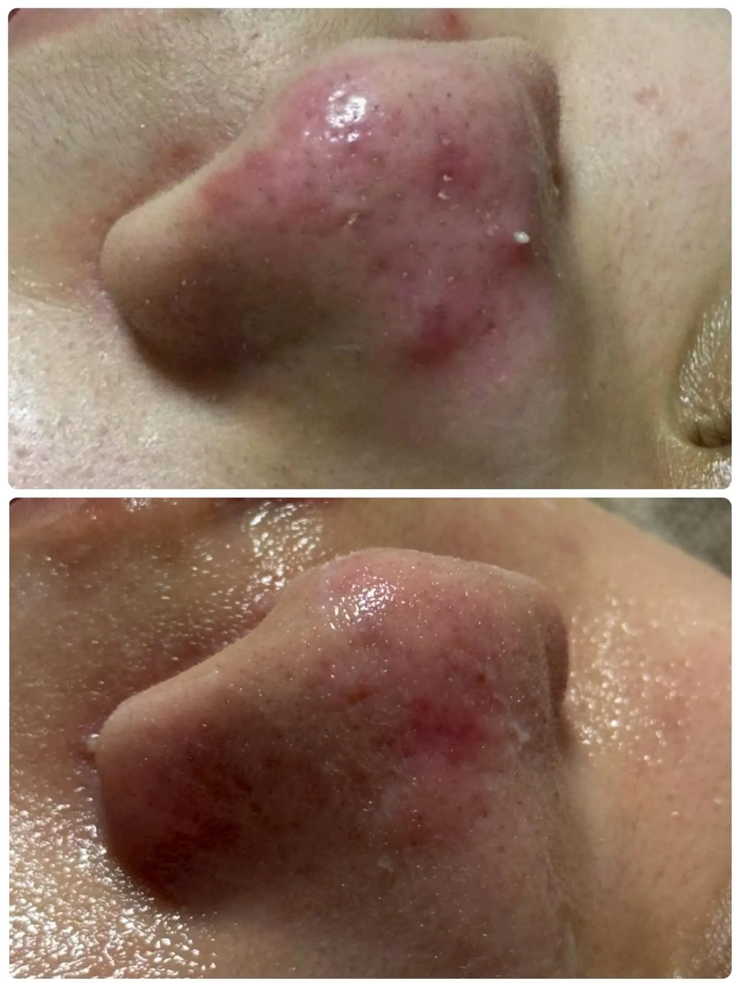 🌱毛穴の詰まり&引き締めケア🌱