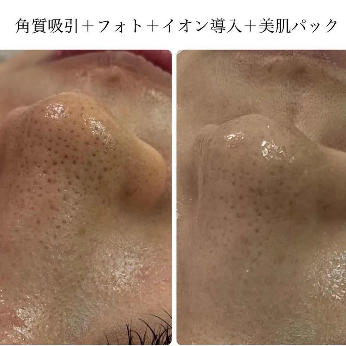 しつこい毛穴悩みにお困りの方は多いと思います！