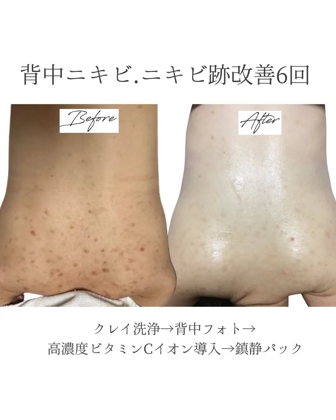 お背中のケアはじめませんか？☺️