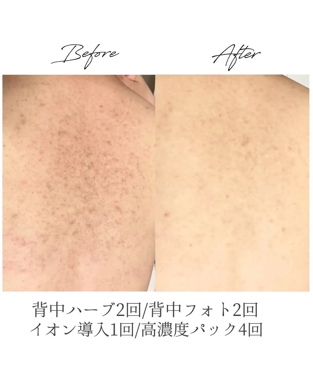 お背中のケアはじめませんか？☺️