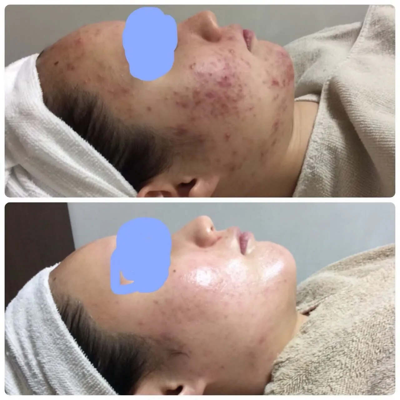 繰り返すニキビを撃退しましょう💆🏼‍♀️✨
