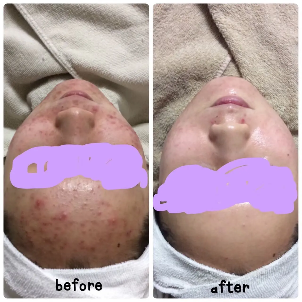 繰り返すニキビを撃退しましょう💆🏼‍♀️✨