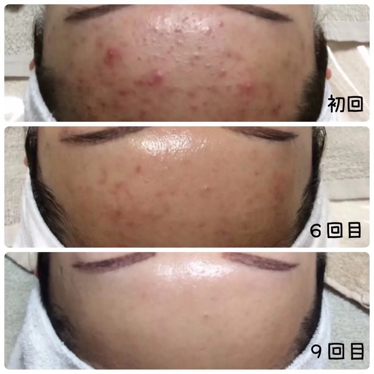 繰り返すニキビを撃退しましょう💆🏼‍♀️✨