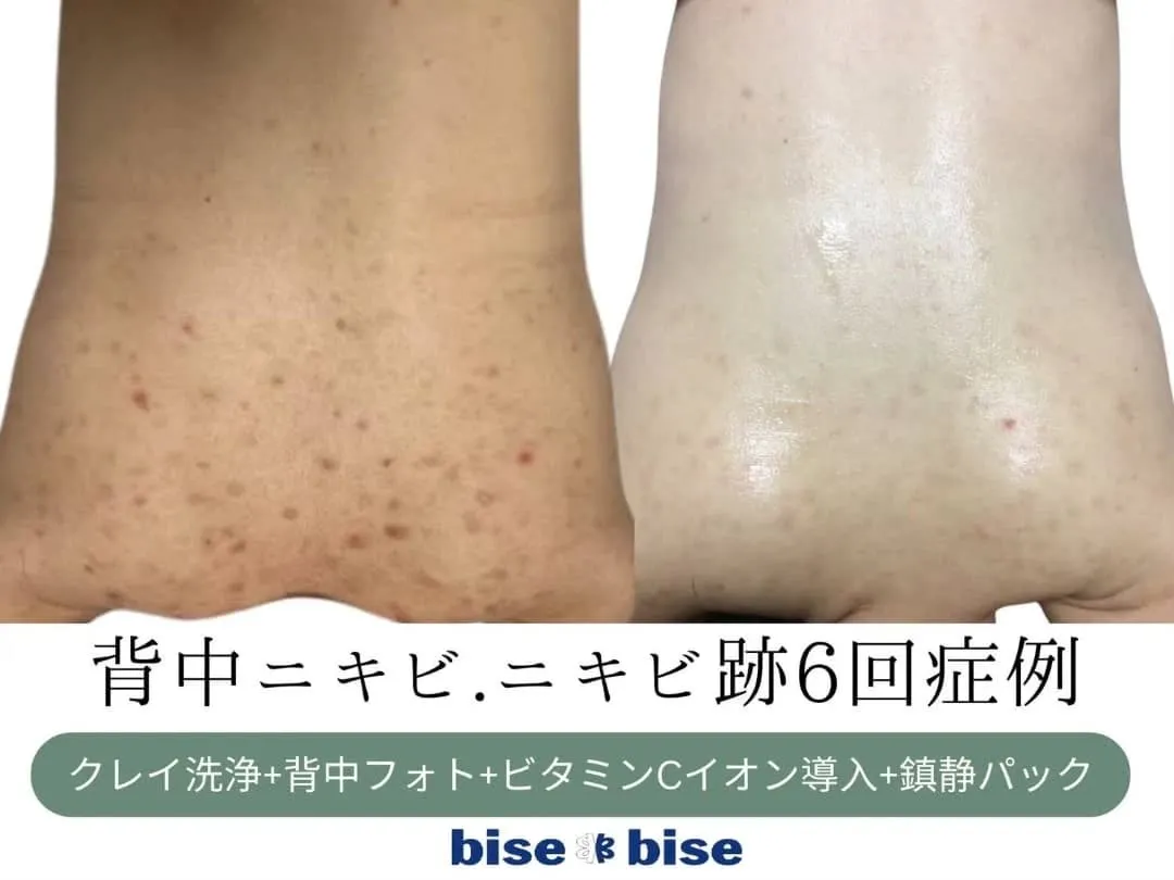 背中ニキビ改善🌸🌿