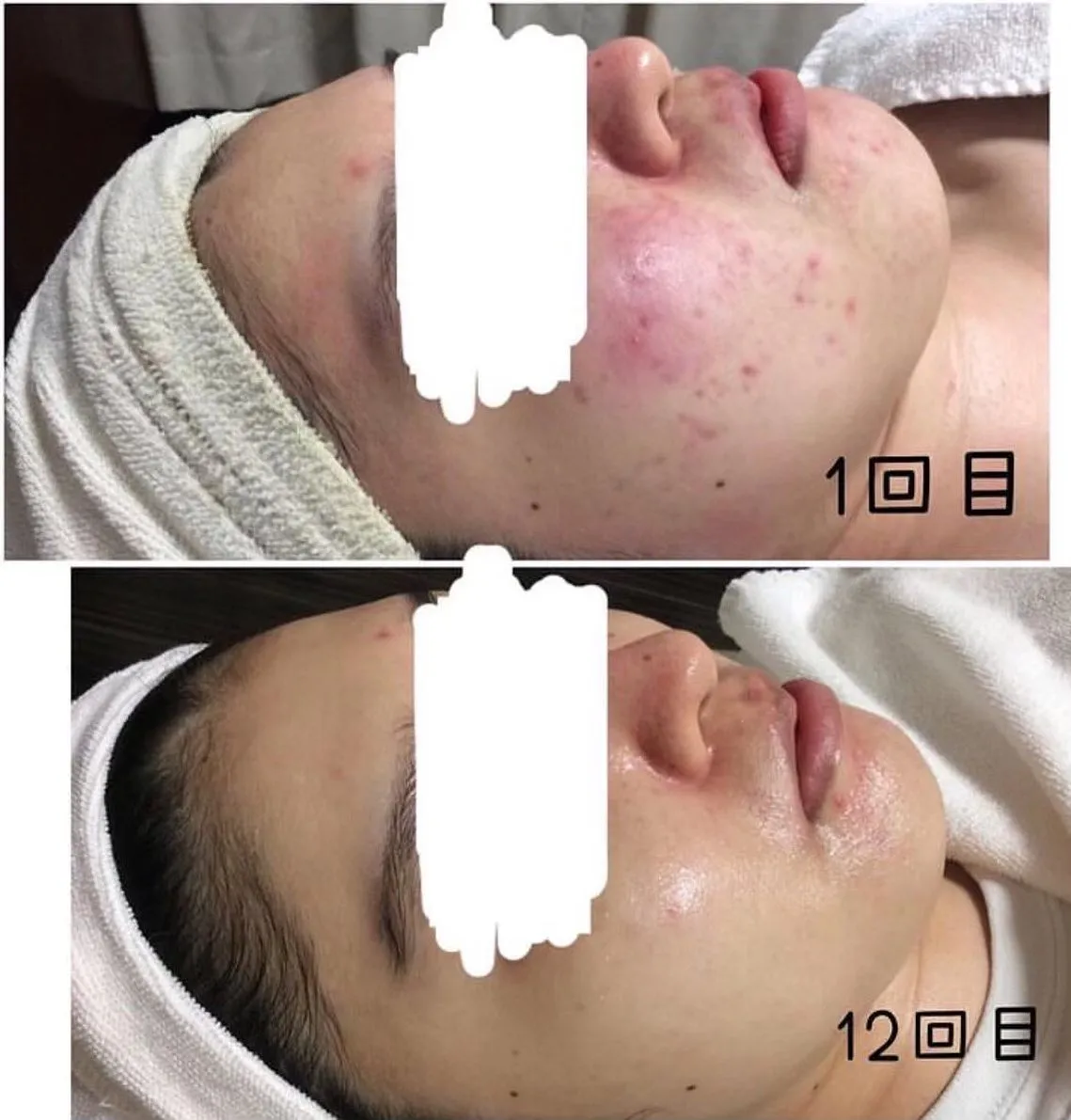 ニキビや赤み、毛穴の開きや詰まりなど様々な肌悩みを肌質改善す...