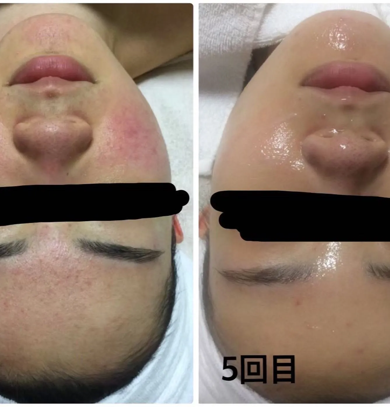 ニキビや赤み、毛穴の開きや詰まりなど様々な肌悩みを肌質改善す...