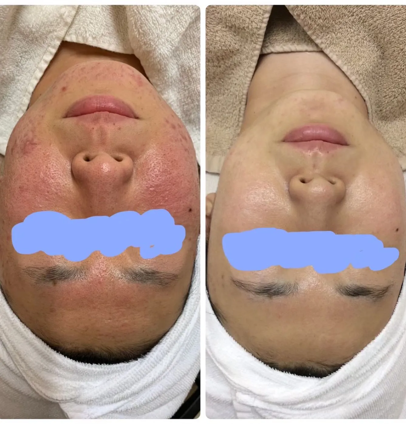 ニキビや赤み、毛穴の開きや詰まりなど様々な肌悩みを肌質改善す...