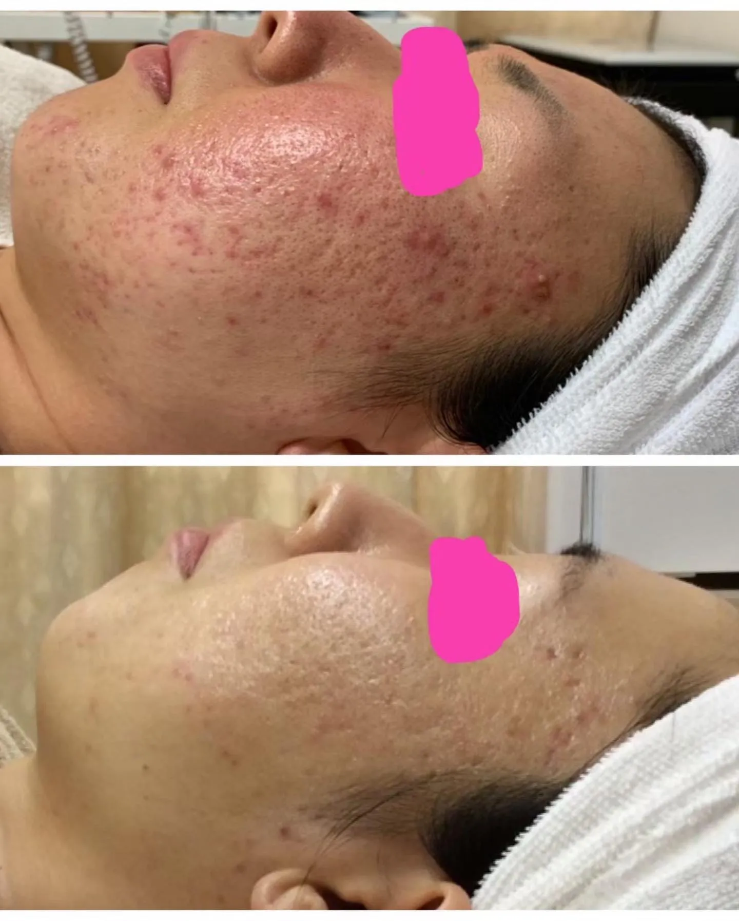 メイクで肌荒れをごまかしたり、高いスキンケア商品を使っている...