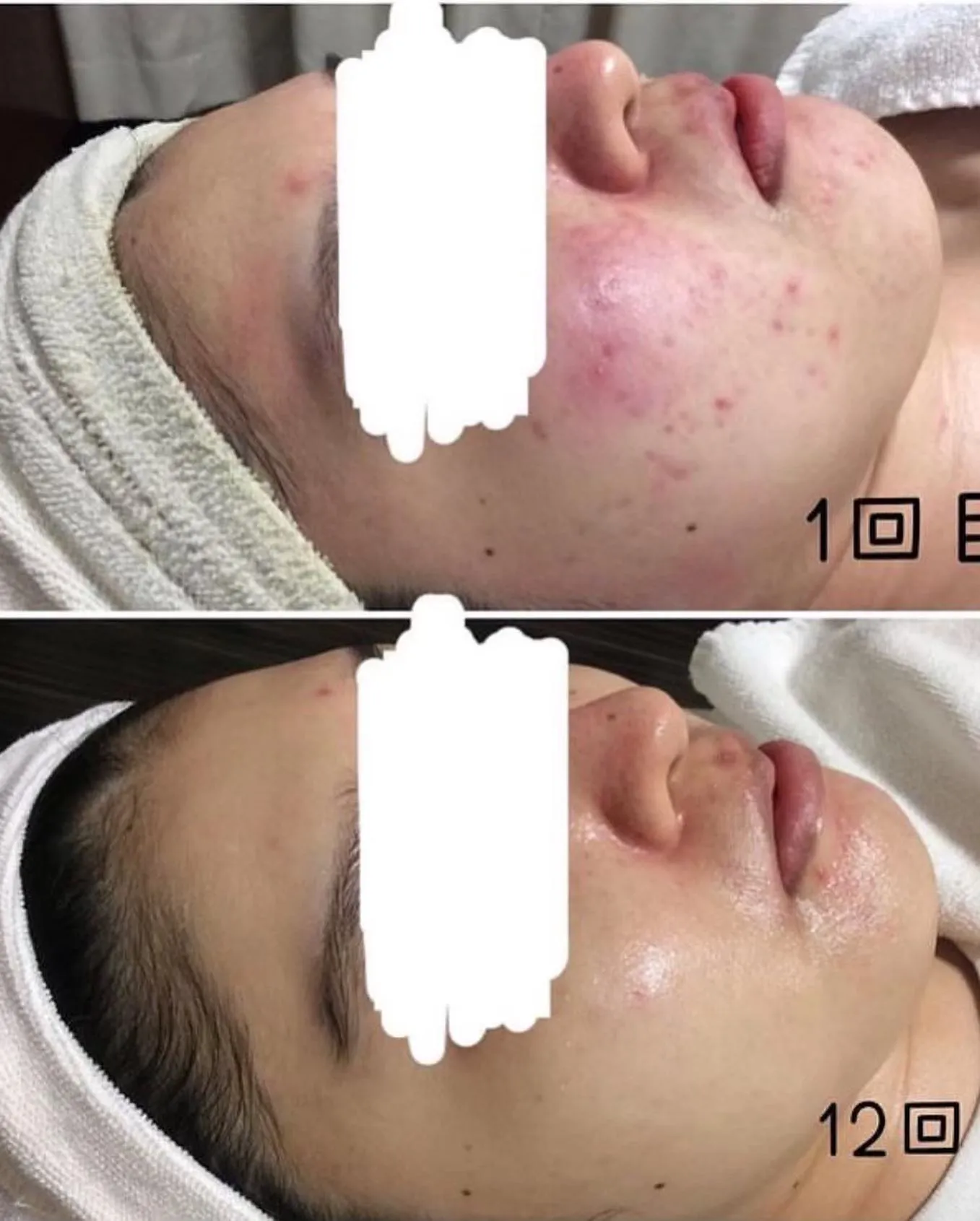 メイクで肌荒れをごまかしたり、高いスキンケア商品を使っている...