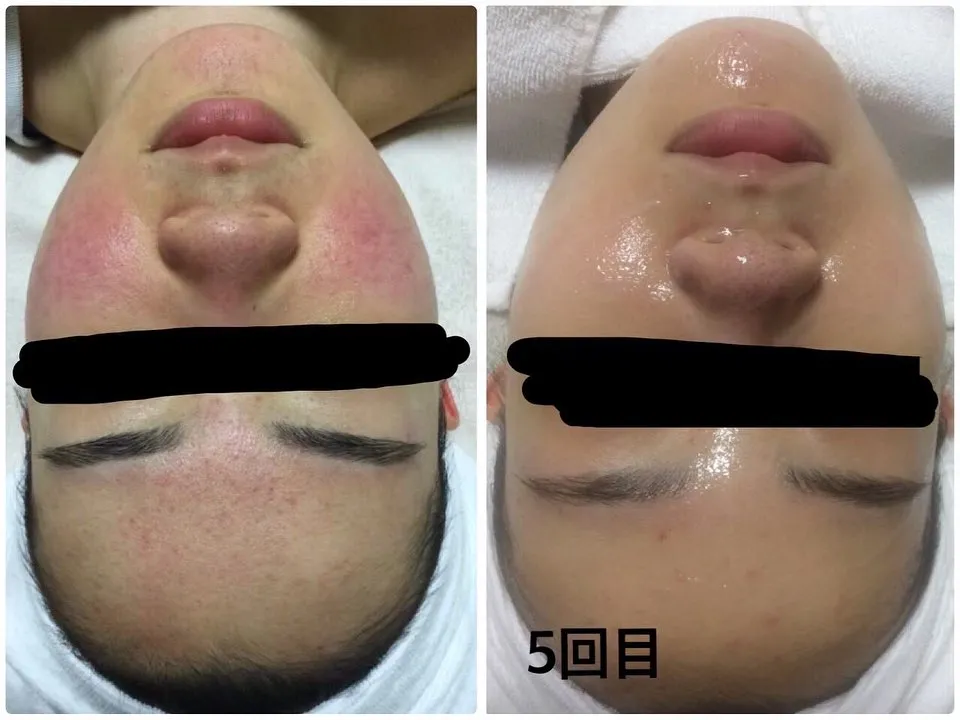 お顔の肌悩みから背中の肌悩みまで特殊なお光を使いお肌を正常...
