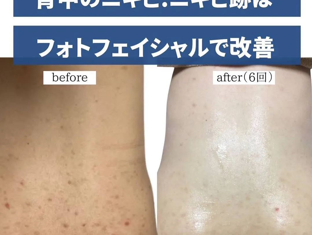 お顔の肌悩みから背中の肌悩みまで特殊なお光を使いお肌を正常...