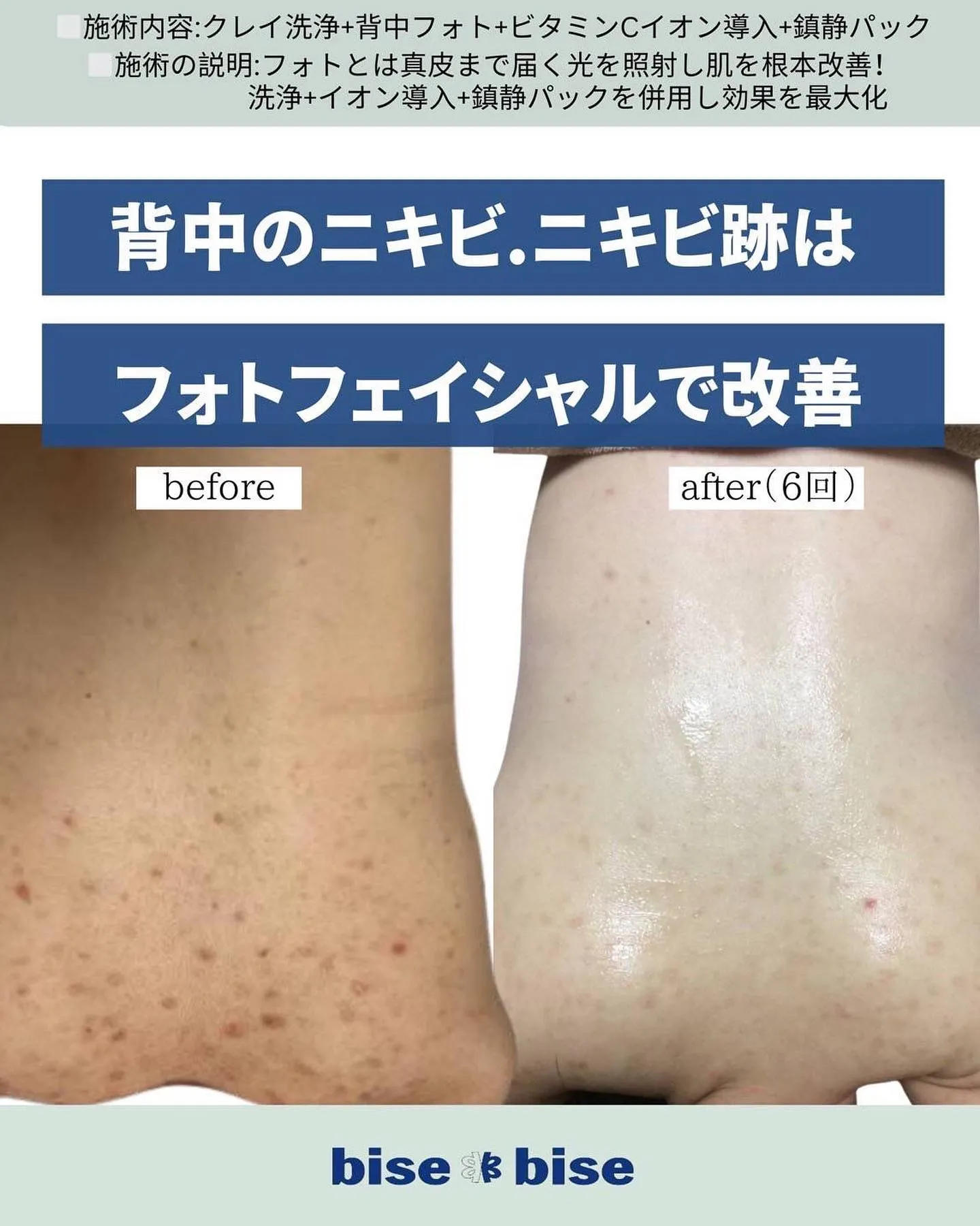 セルフケアの難しいお背中や中々改善されないお顔のトラブルもお...