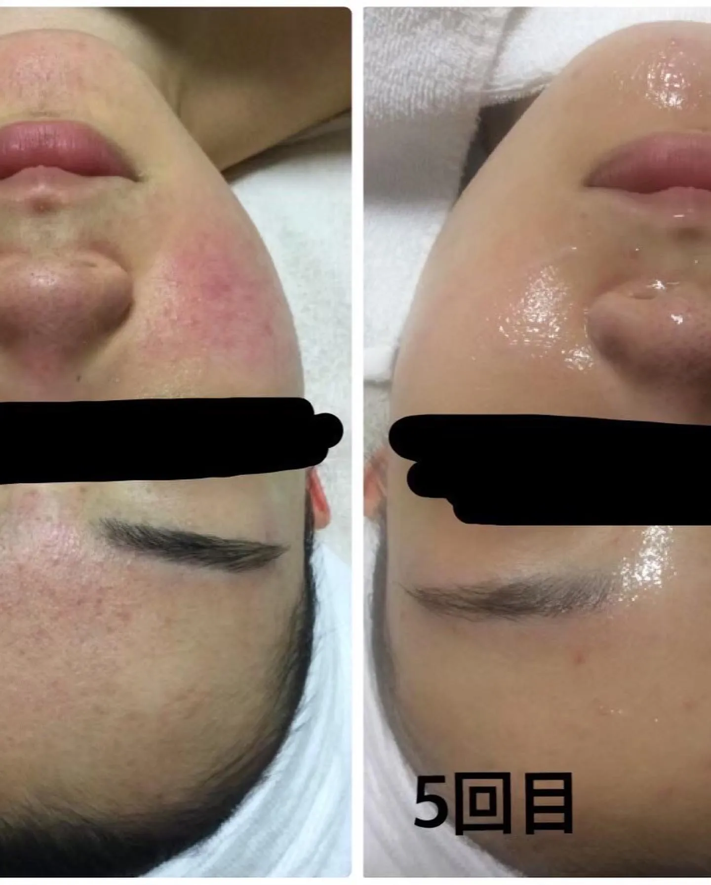 セルフケアの難しいお背中や中々改善されないお顔のトラブルもお...
