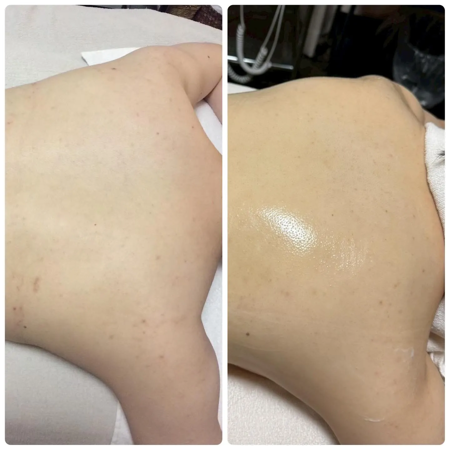 🧼海に行く前に背中をチェックしてみてください🧼