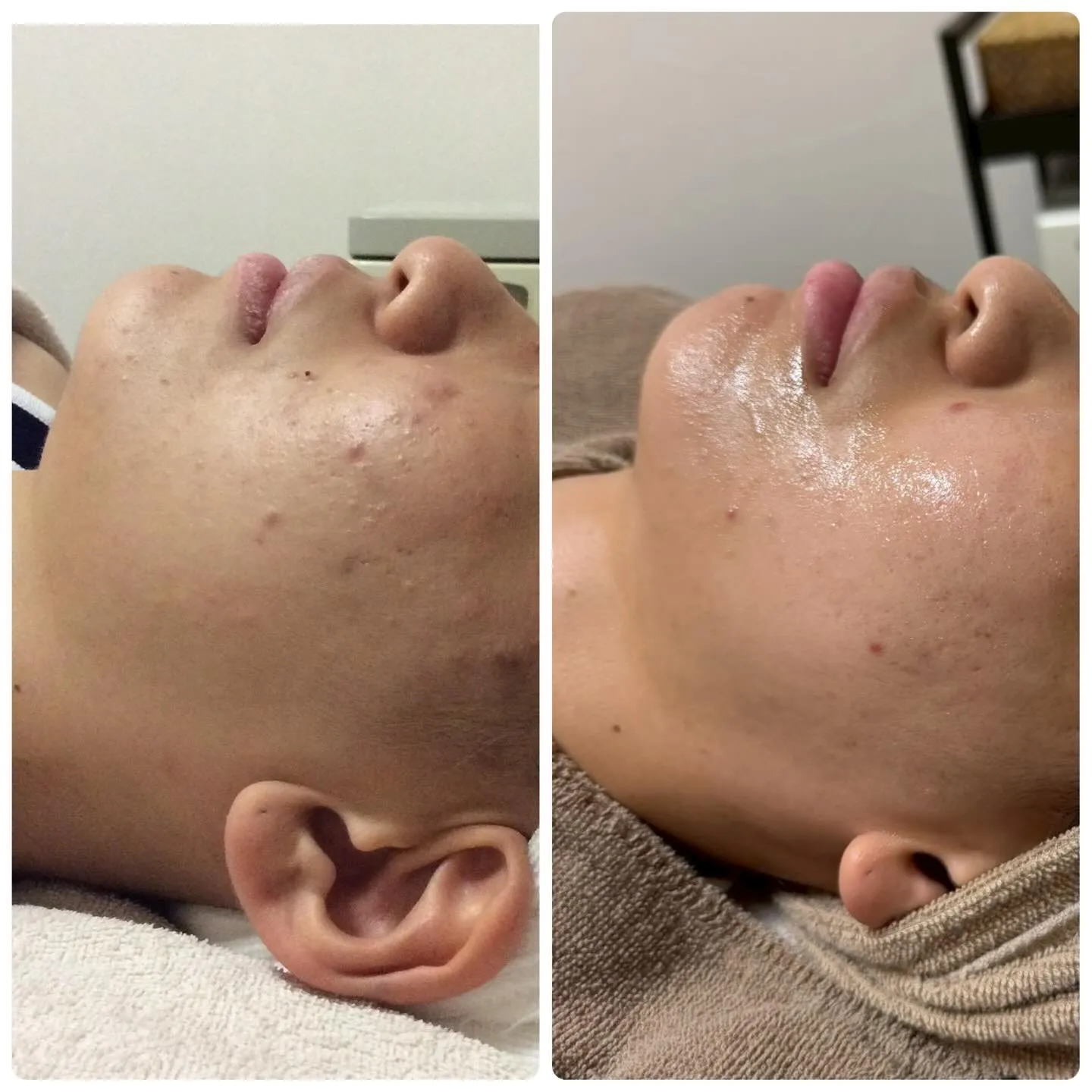 👩‍🔬フォトフェイシャルで美肌のケアを始めましょう👩‍🔬