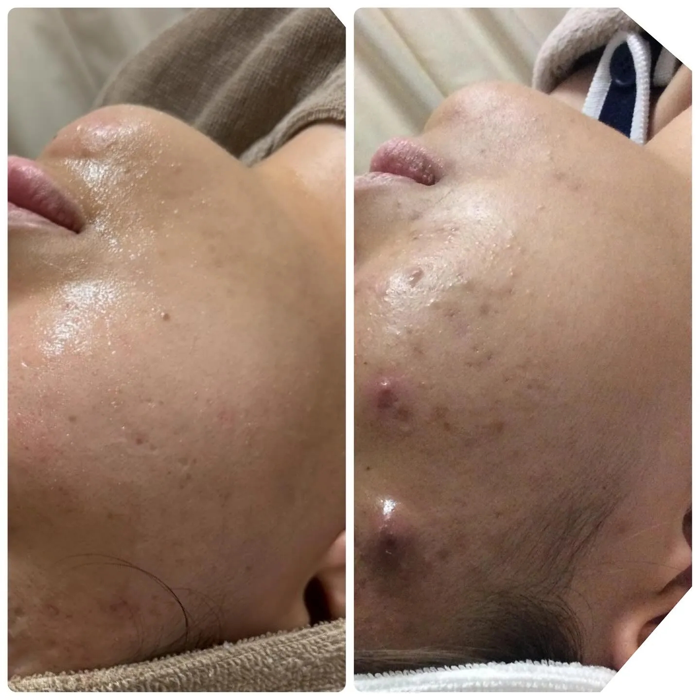 👩‍🔬フォトフェイシャルで美肌のケアを始めましょう👩‍🔬