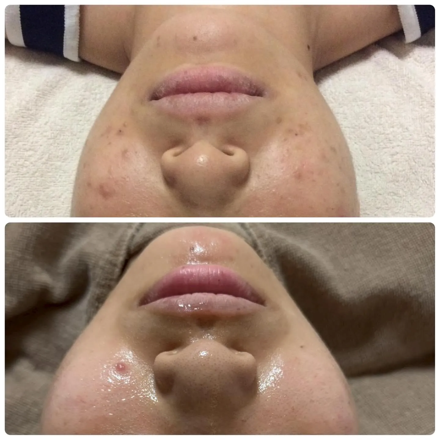 👩‍🔬フォトフェイシャルで美肌のケアを始めましょう👩‍🔬