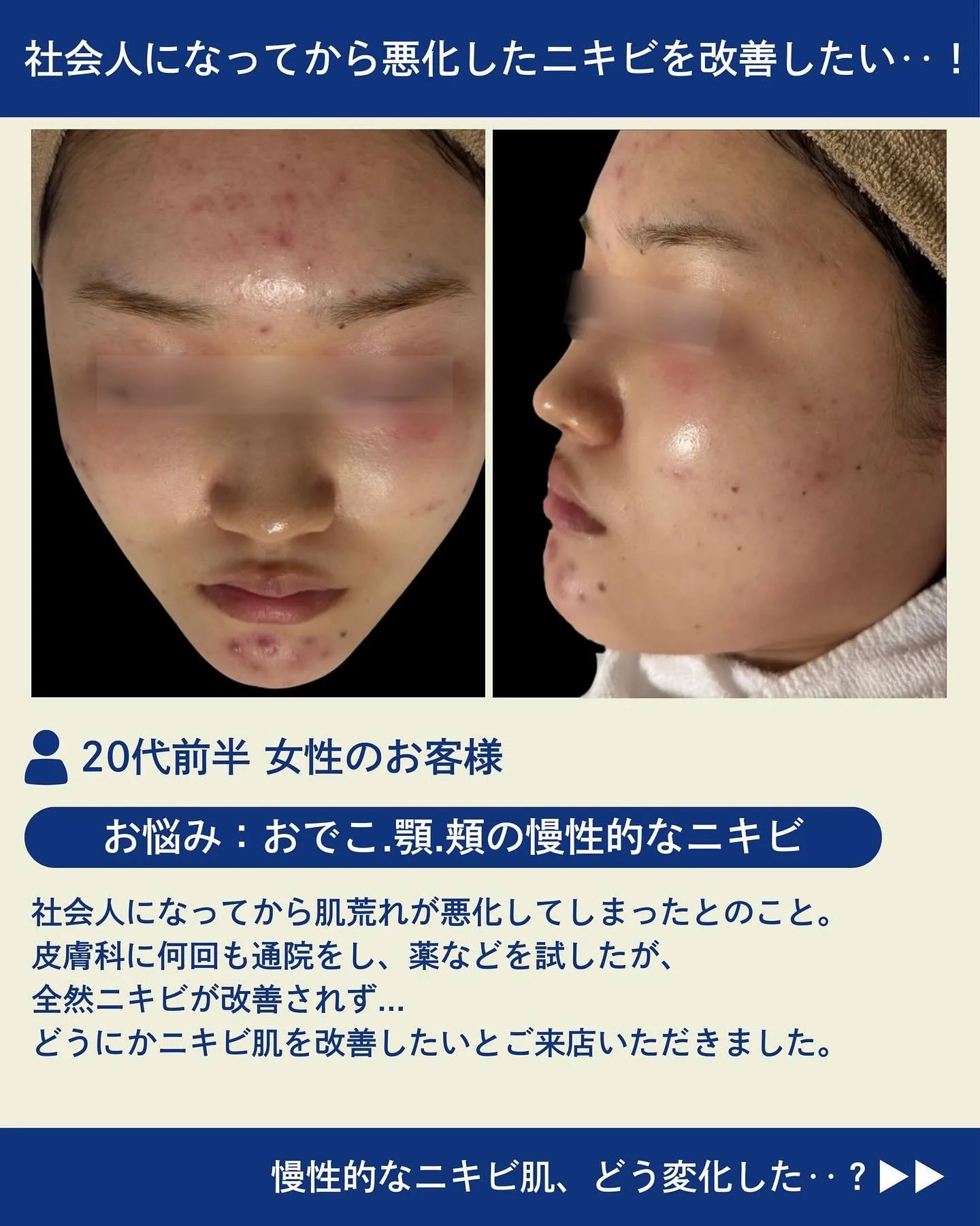 🏥フォトフェイシャルでお肌悩みを根本改善🏥