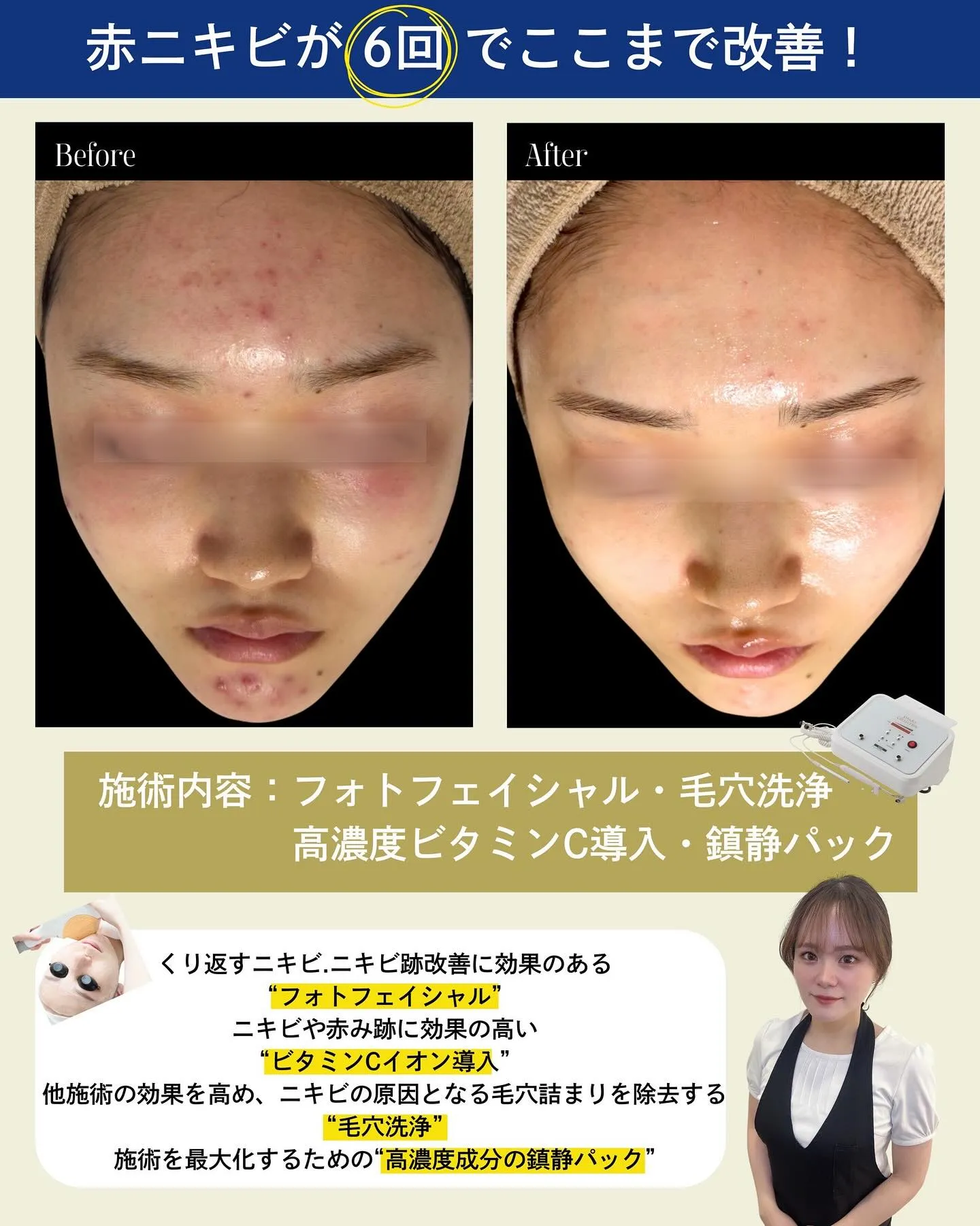 🏥フォトフェイシャルでお肌悩みを根本改善🏥