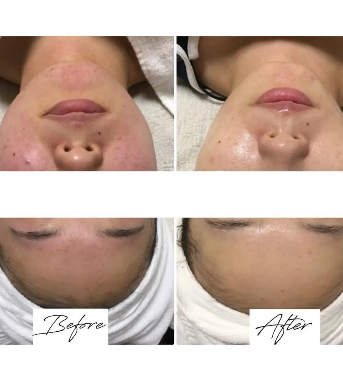 O.H.Lハーブピーリング🌿