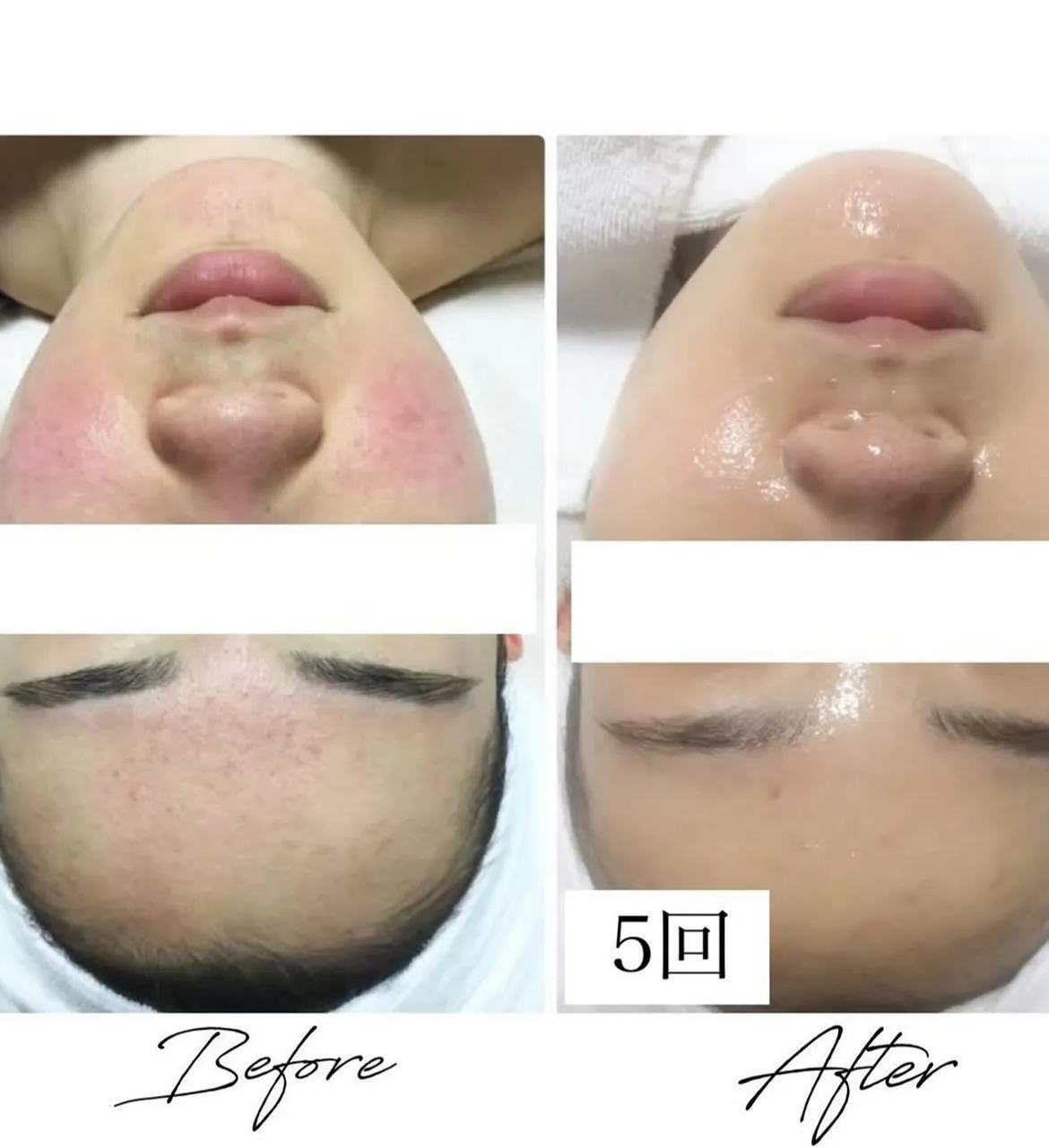 O.H.Lハーブピーリング🌿