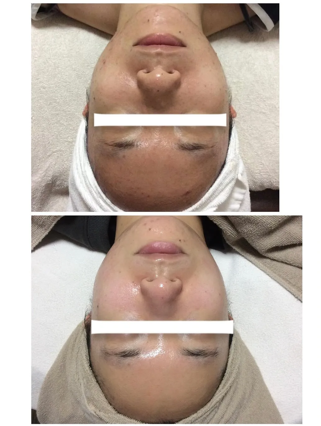 ☘️ニキビケア☘️