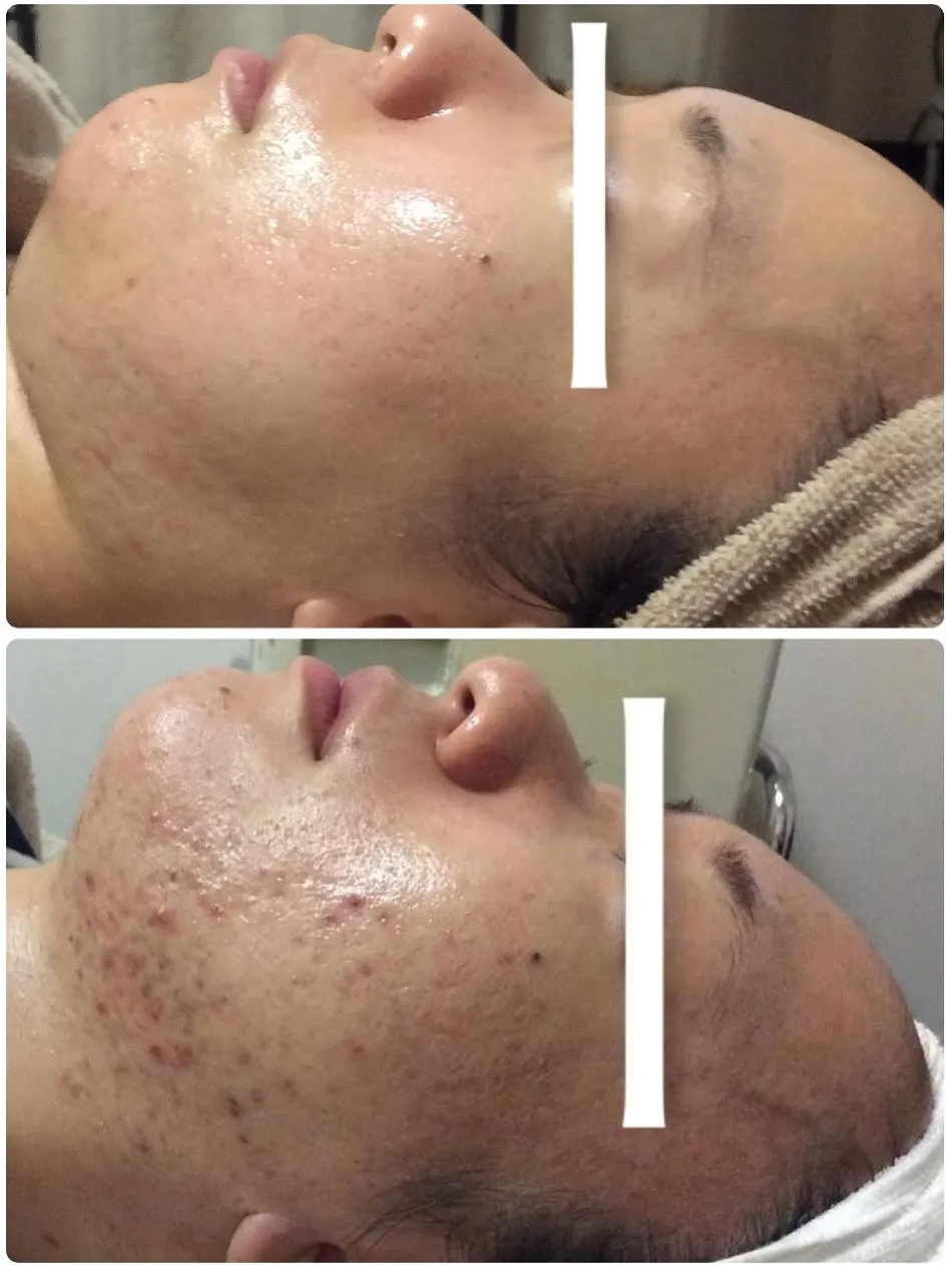 ☘️ニキビケア☘️