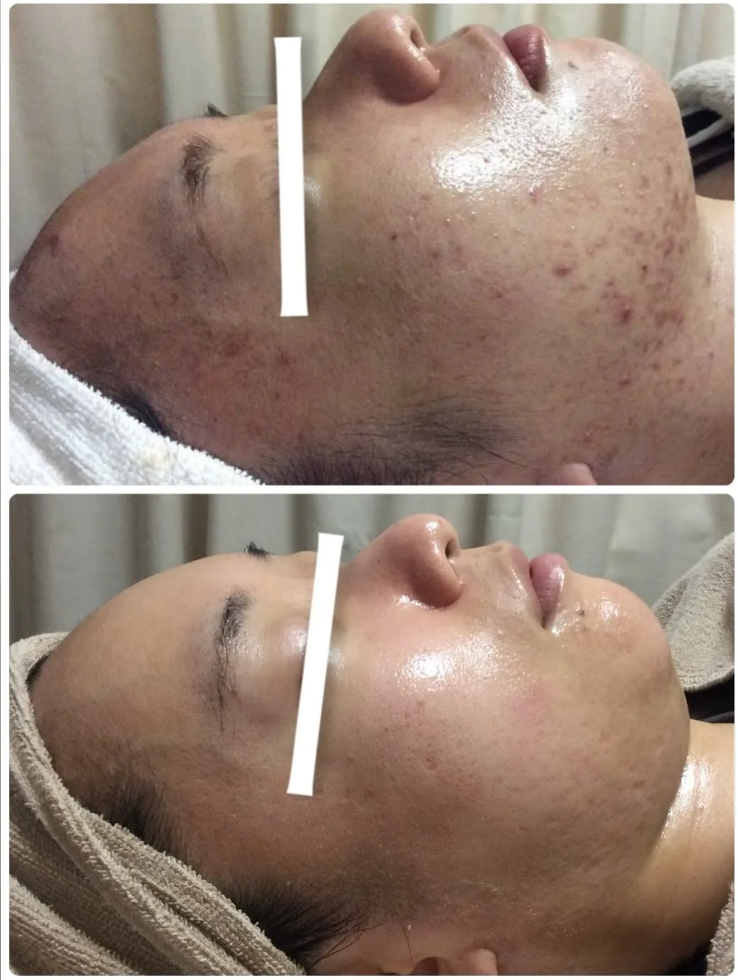 ☘️ニキビケア☘️