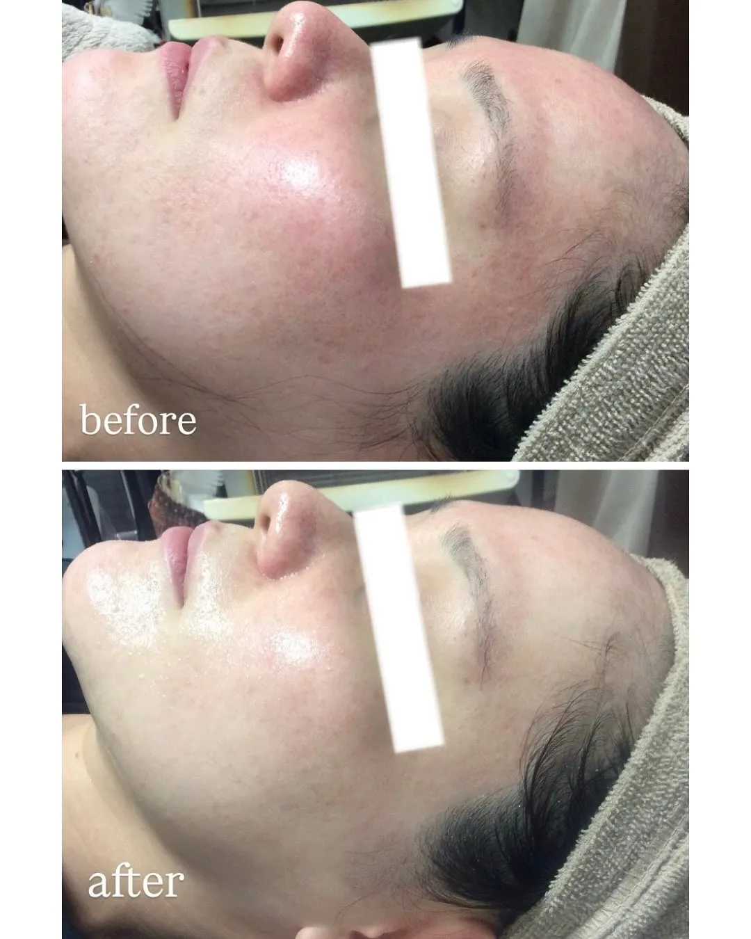 \忘年会・クリスマス🎄前にツルすべ肌へ/