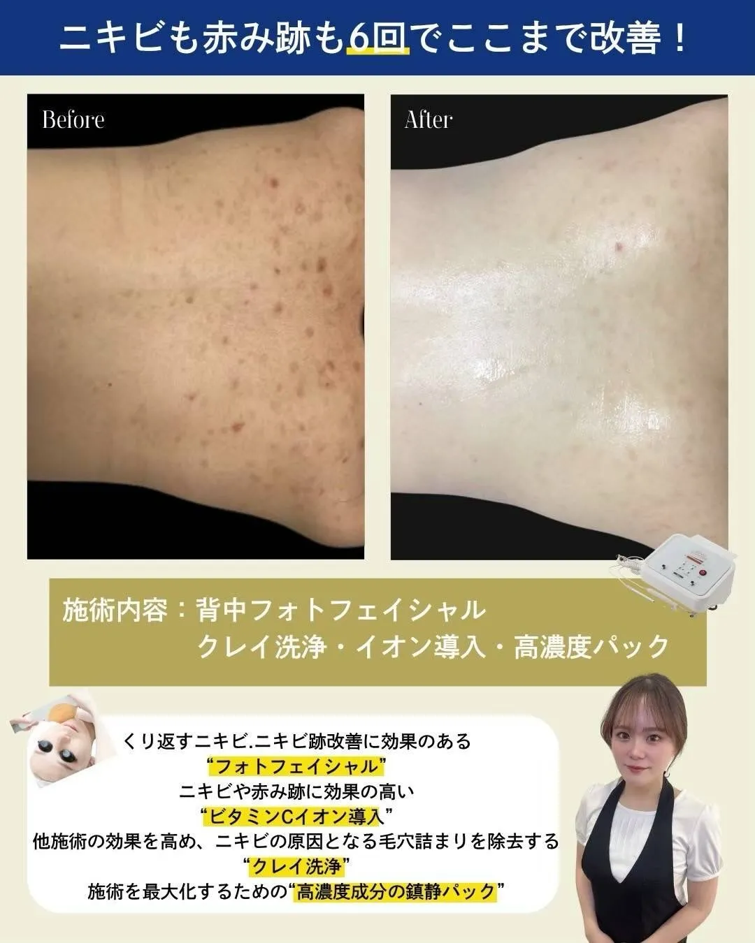 【来年の自分のために、今から“背中ケア”はじめませんか？】