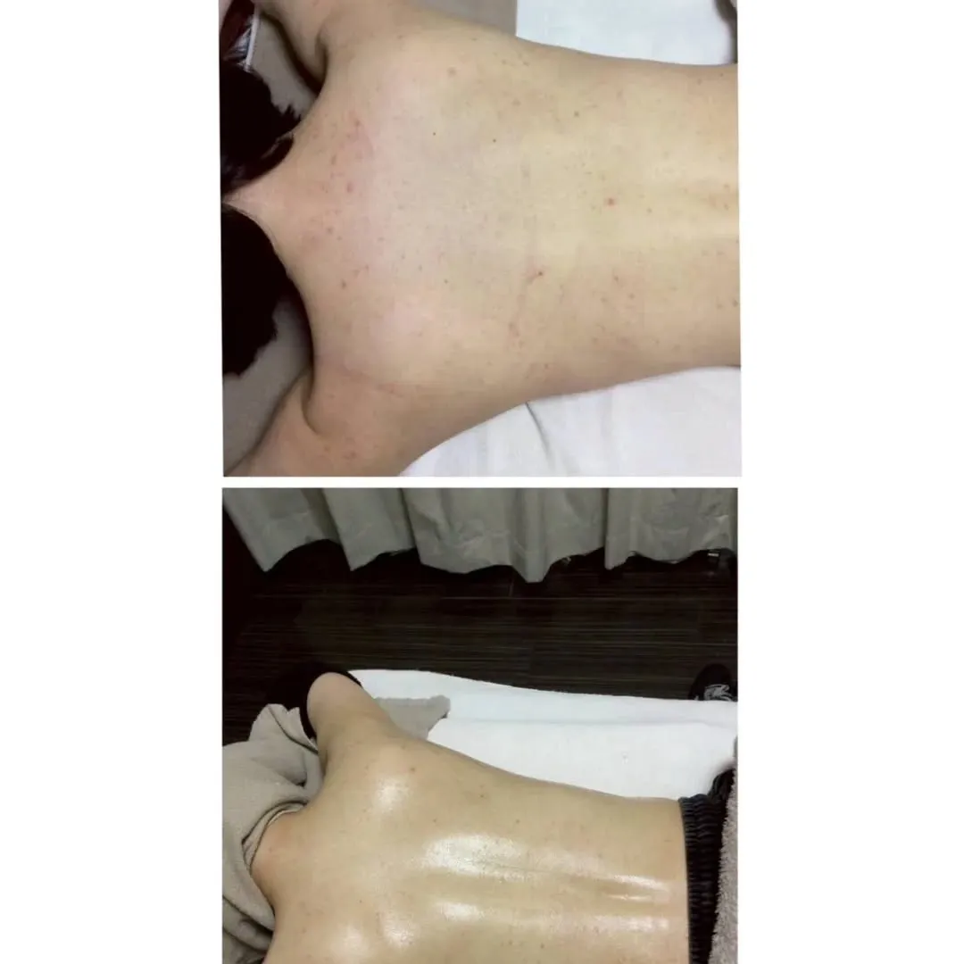 背中ニキビ改善🍀