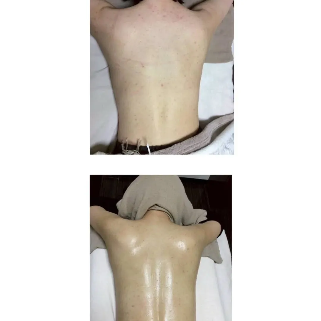 背中ニキビ改善🍀