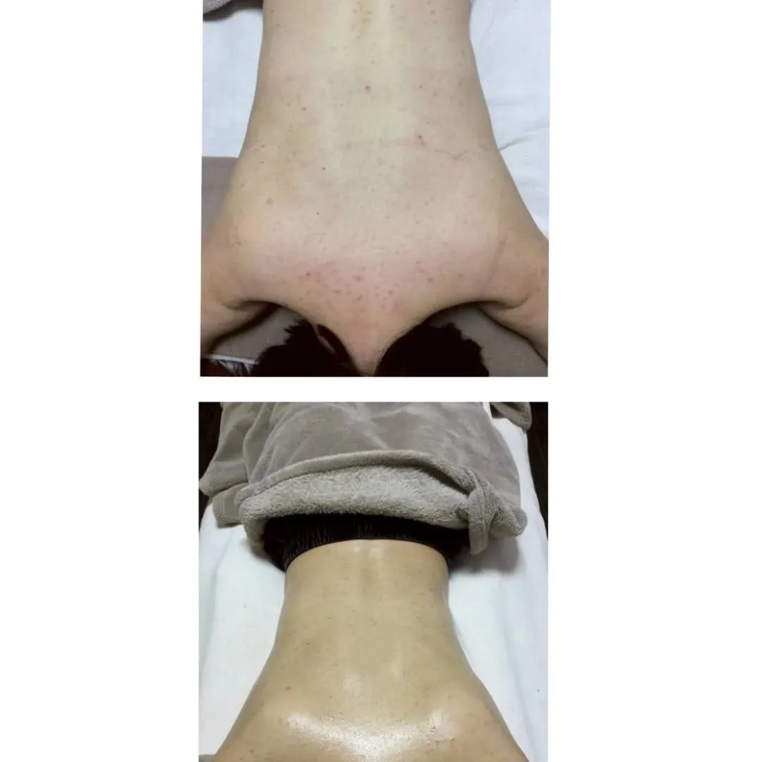 背中ニキビ改善🍀