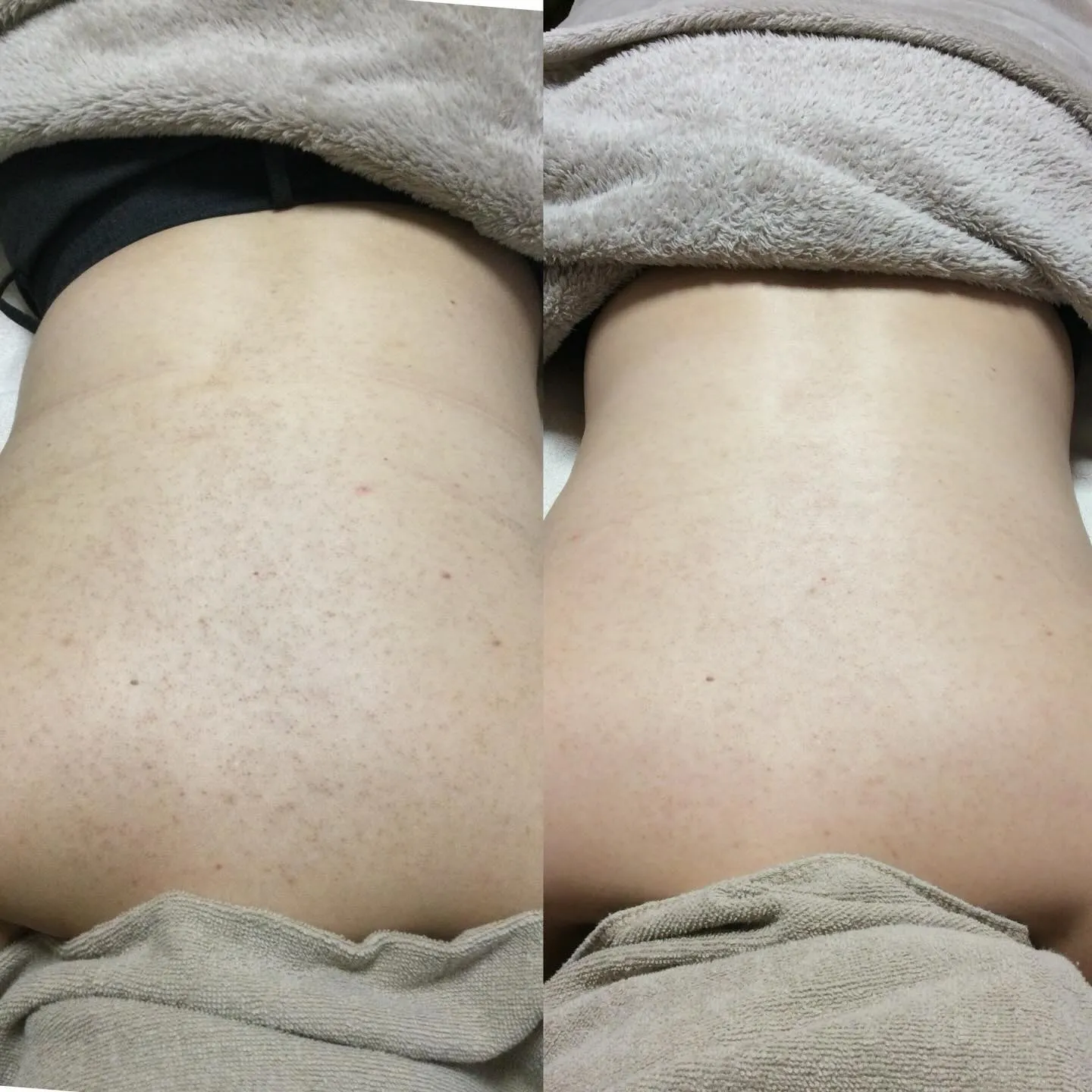 ❄️冬こそ背中のケアは重要です❄️