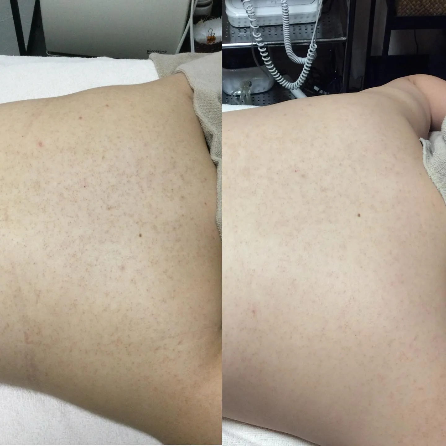 ❄️冬こそ背中のケアは重要です❄️