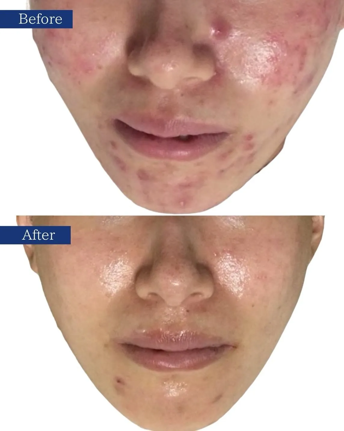 🧧年末年始の暴飲暴食による肌トラブルは放置しないでください！...