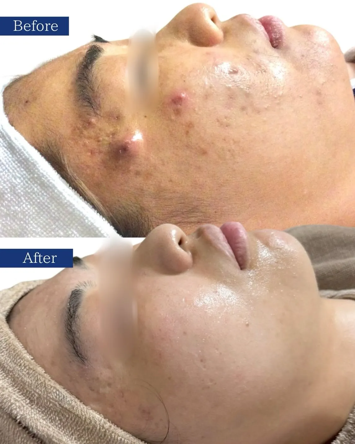 🧧年末年始の暴飲暴食による肌トラブルは放置しないでください！...