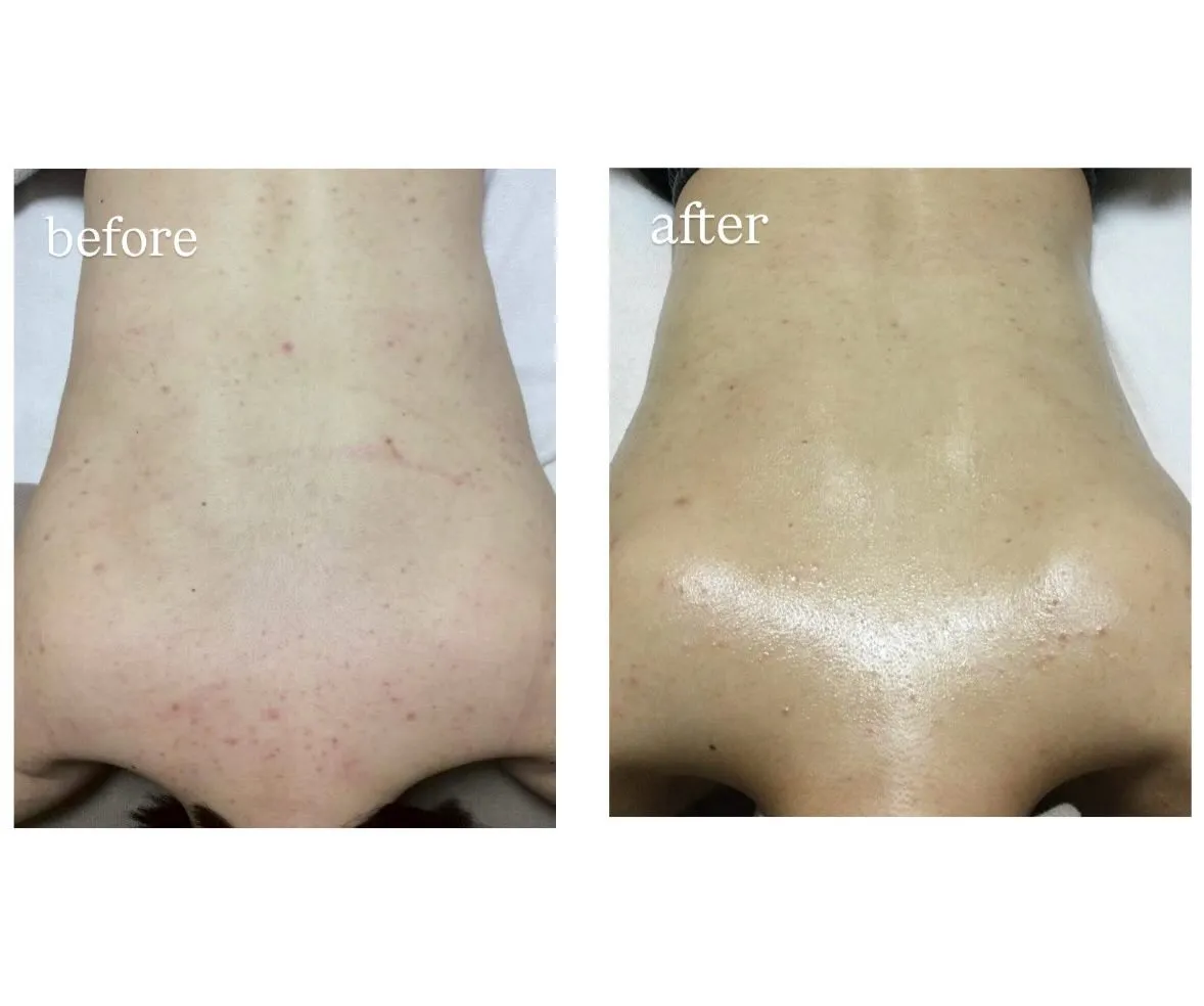 今年の夏は自信を持てるお背中に🐬✨