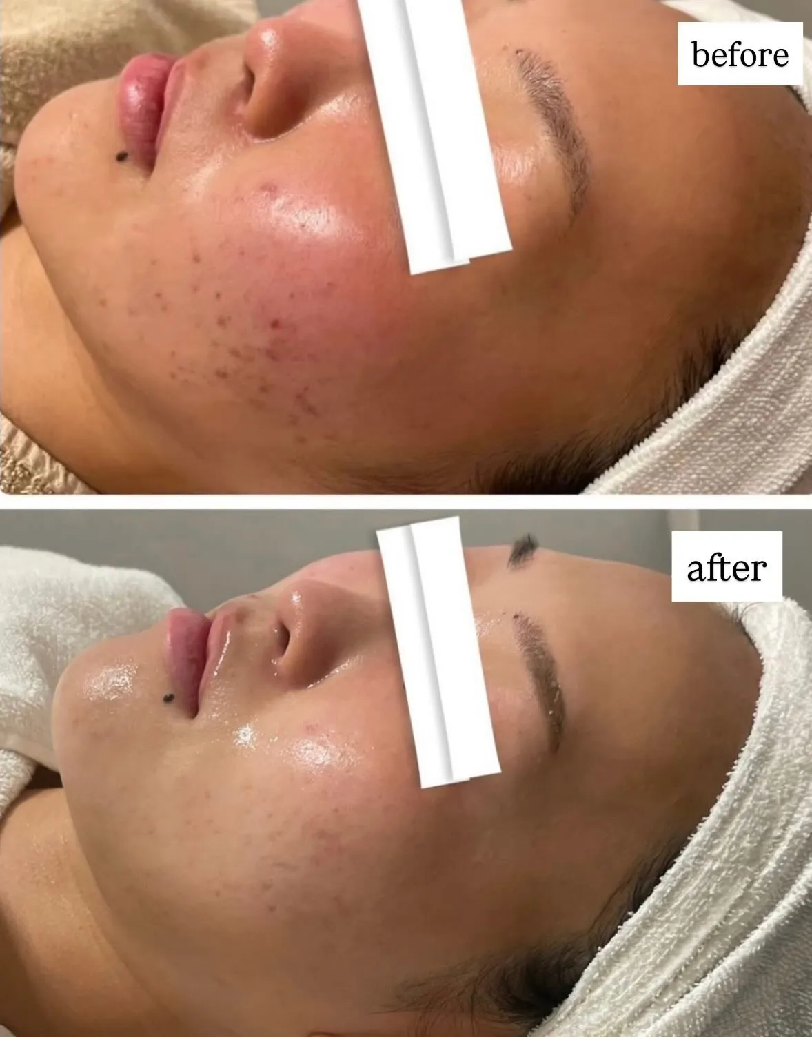 ニキビニキビ痕を改善しましょう👍🏻！