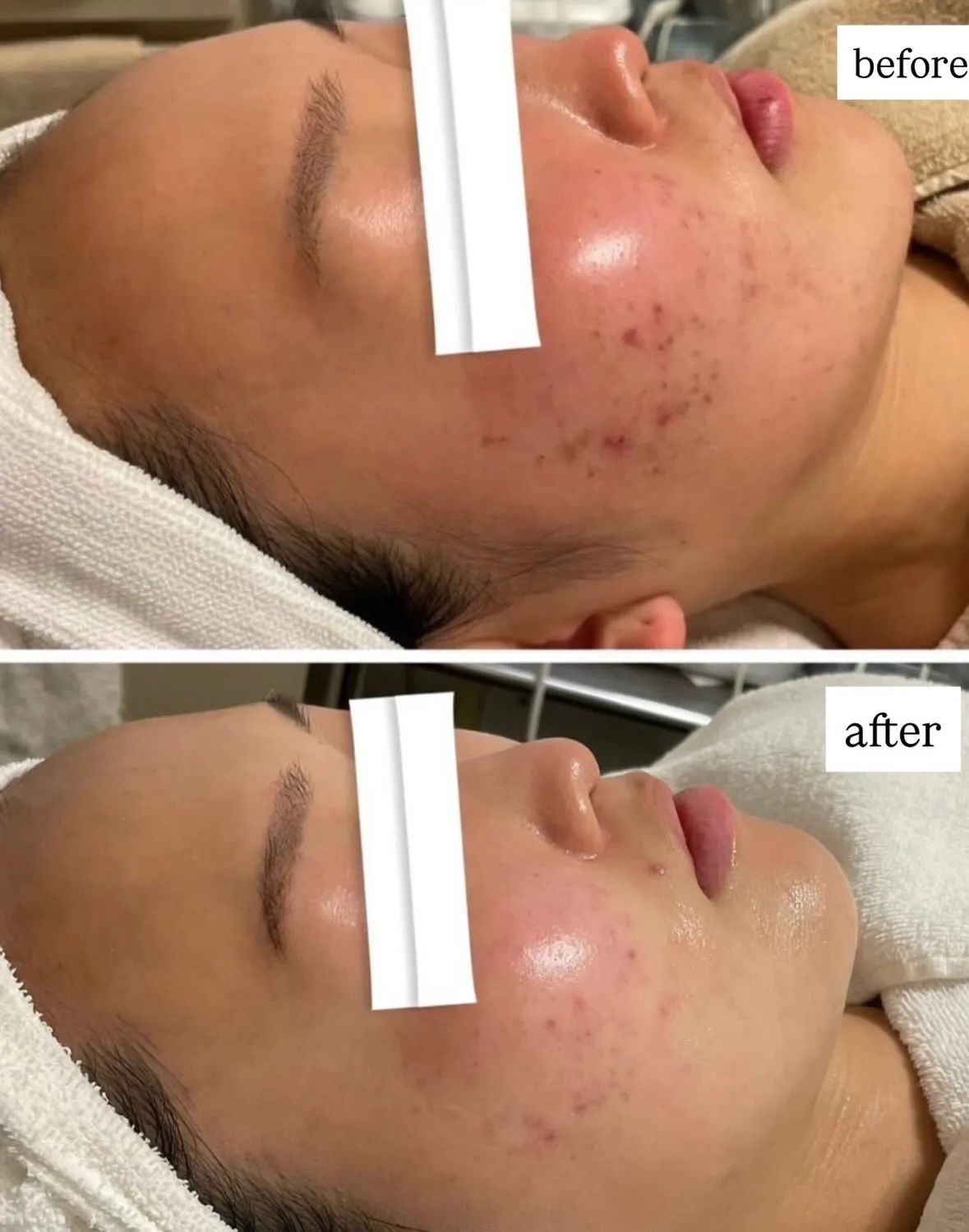 ニキビニキビ痕を改善しましょう👍🏻！