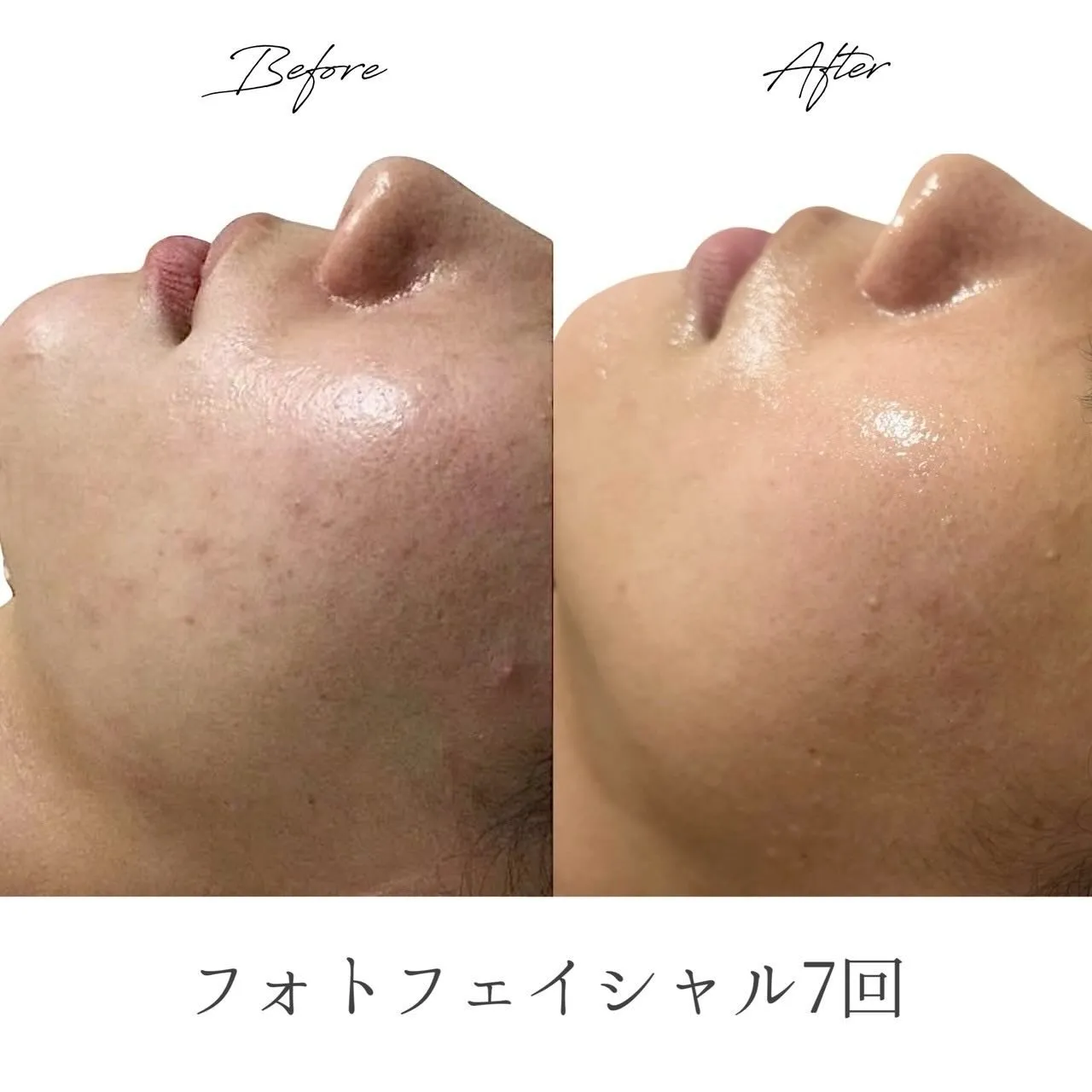 💉フォトフェイシャル＋前後のケアで肌トラブルを根本改善💉