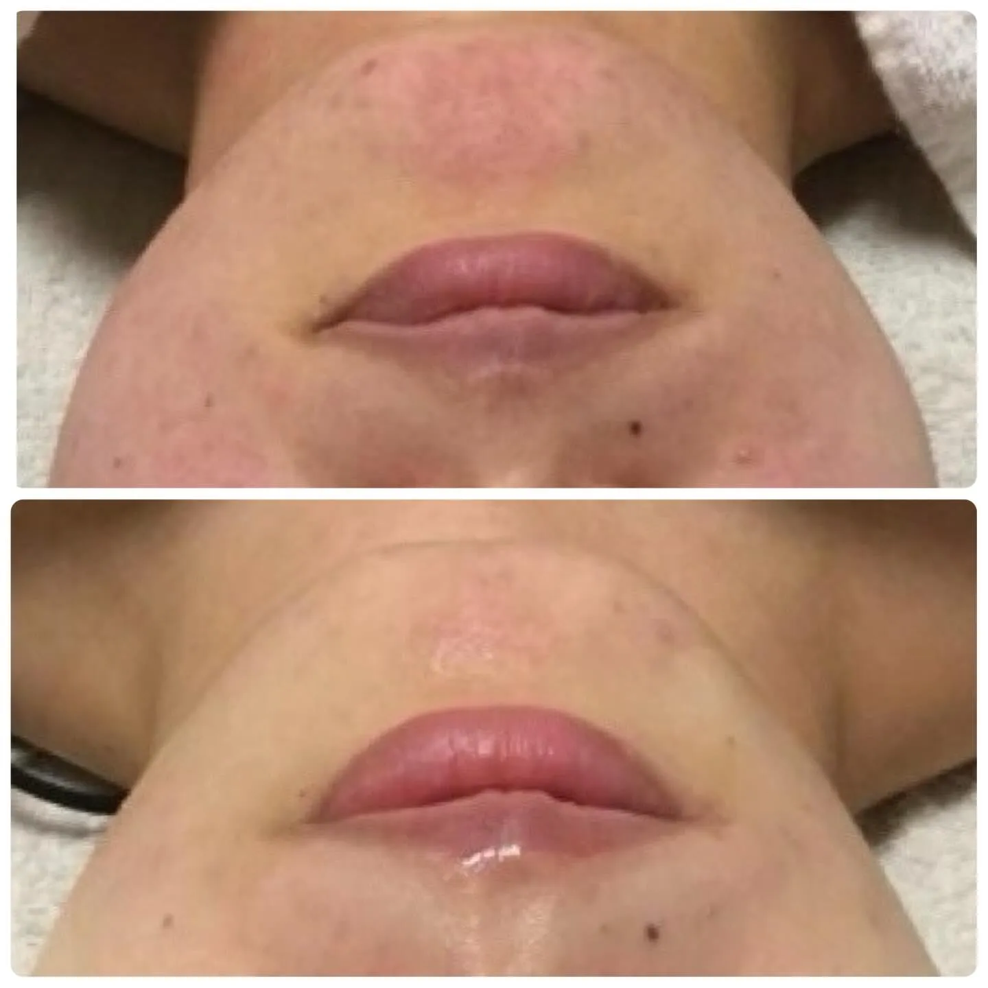 💉フォトフェイシャル＋前後のケアで肌トラブルを根本改善💉