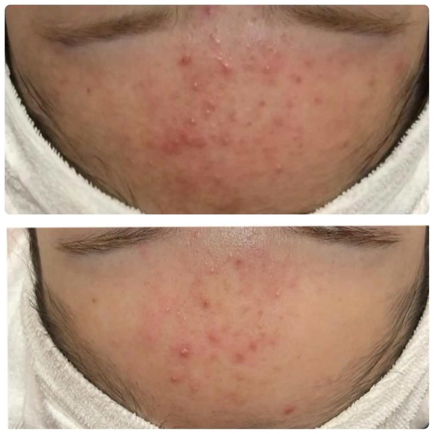 💉フォトフェイシャル＋前後のケアで肌トラブルを根本改善💉