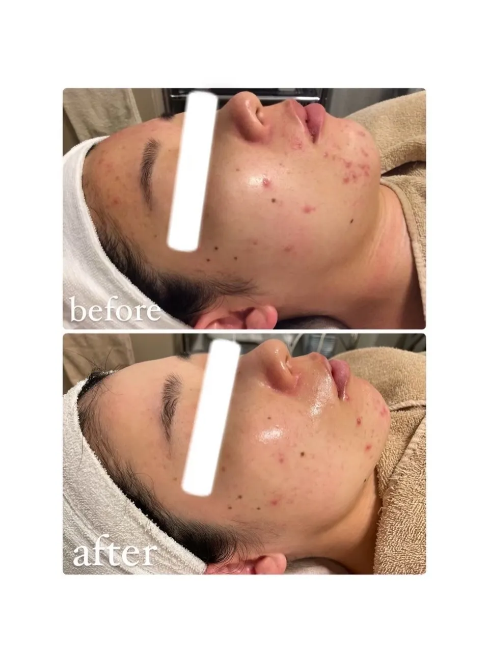 フォトフェイシャルでニキビケア✨