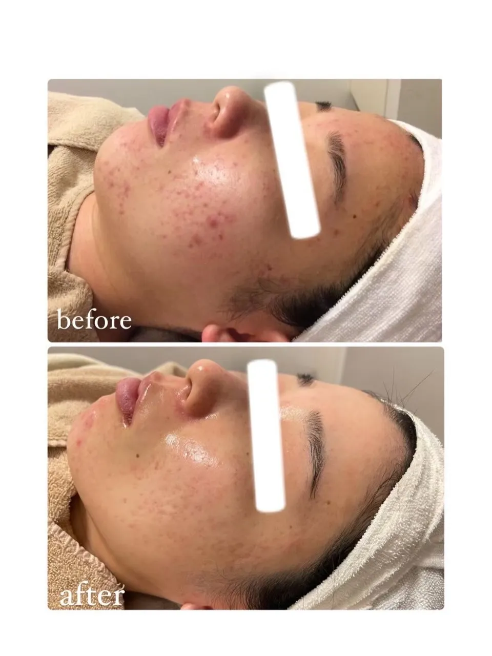 フォトフェイシャルでニキビケア✨