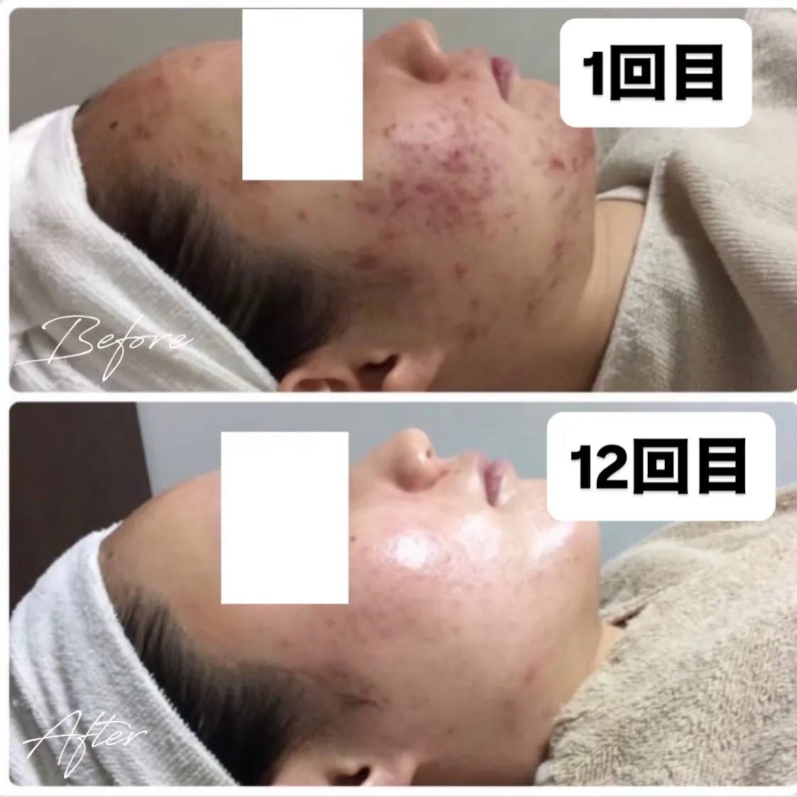 フォト美顔でお肌の内側から