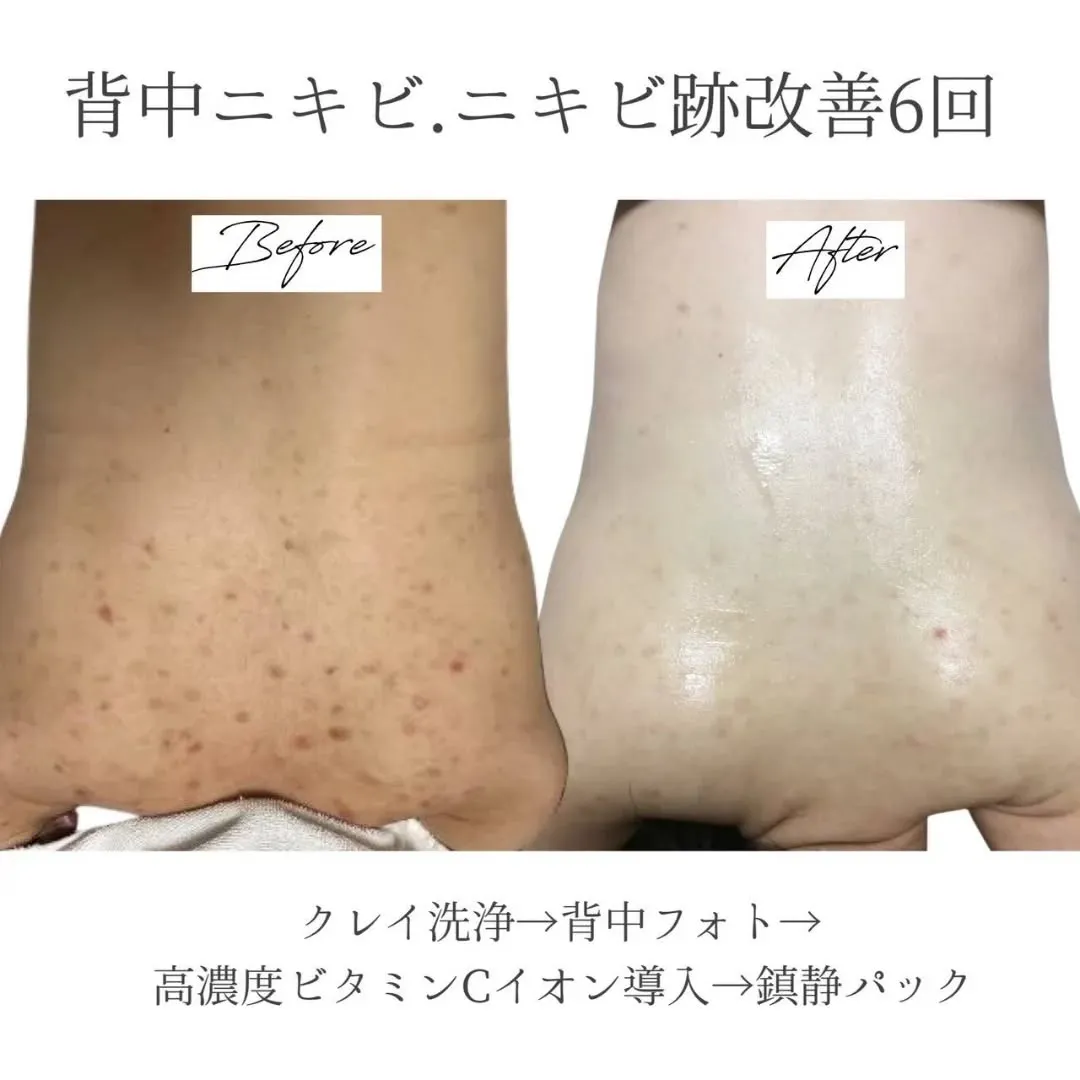 今年こそお背中の空いた服を着たい！