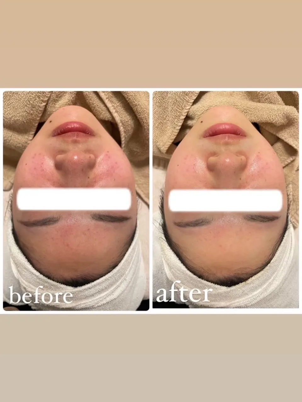 🌿ハーブピーリング症例🌿