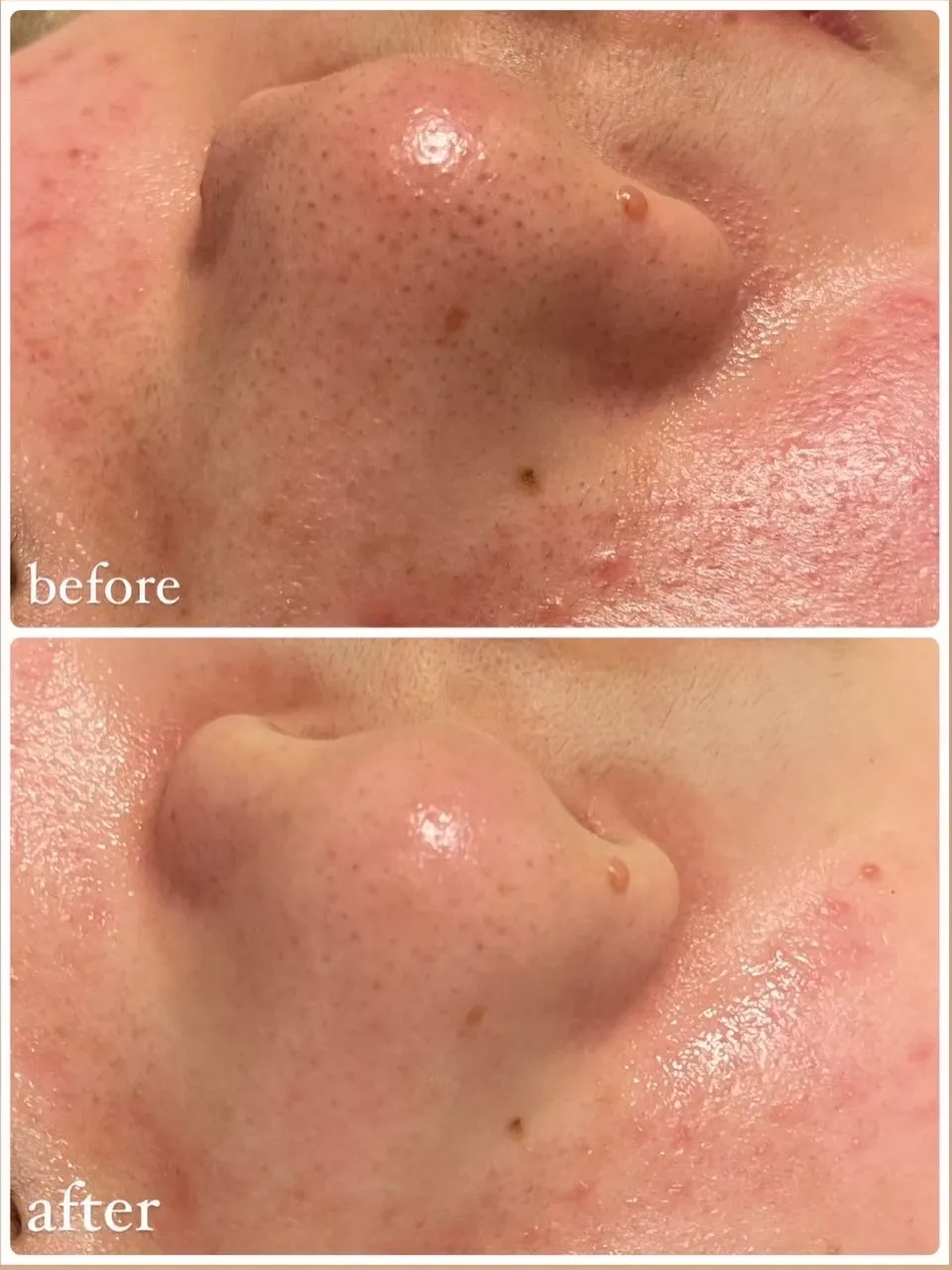 🌿ハーブピーリング症例🌿
