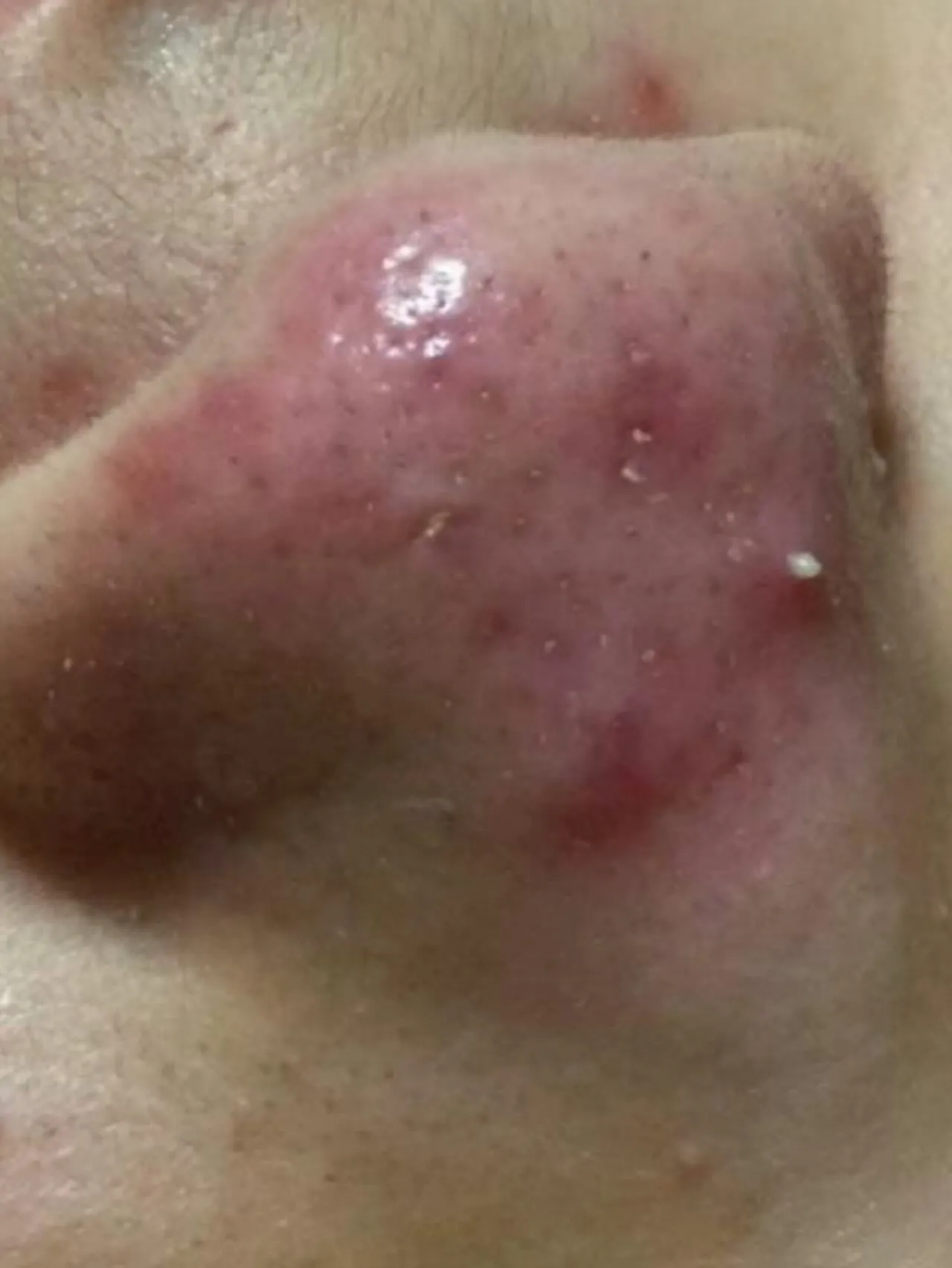 🌱毛穴の詰まり&引き締めケア🌱